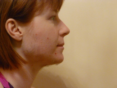 SIDE FACE DAY 30